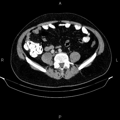 Acute pancreatitis (Radiopaedia 85390-101010 Axial C+ portal venous phase 73).jpg