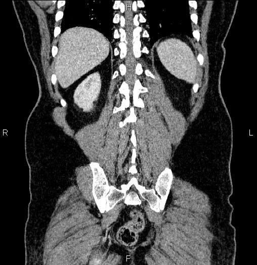 File:Acute pancreatitis (Radiopaedia 85390-101010 Coronal C+ portal venous phase 61).jpg