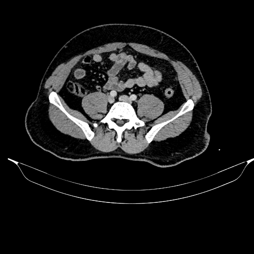 Acute pancreatitis (Radiopaedia 87428-103757 Axial C+ portal venous phase 69).jpg