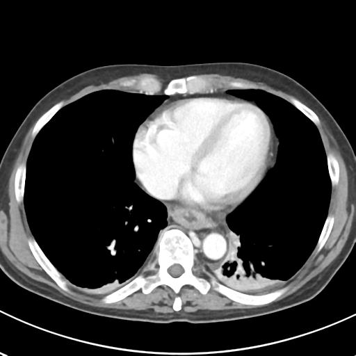 File:Acute pancreatitis and walled-off necrosis (Radiopaedia 29888-30404 Axial C+ portal venous phase 3).jpg