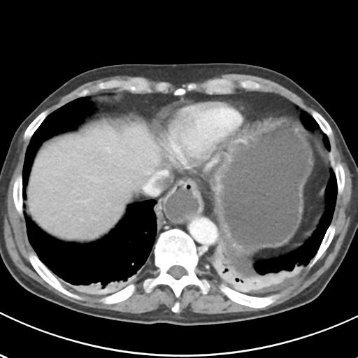 File:Acute pancreatitis and walled-off necrosis (Radiopaedia 29888-30404 Axial C+ portal venous phase 9).jpg