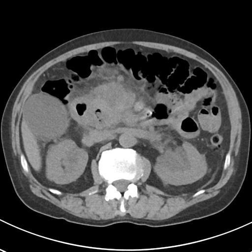 File:Acute pancreatitis and walled-off necrosis (Radiopaedia 29888-30404 Axial non-contrast 31).jpg