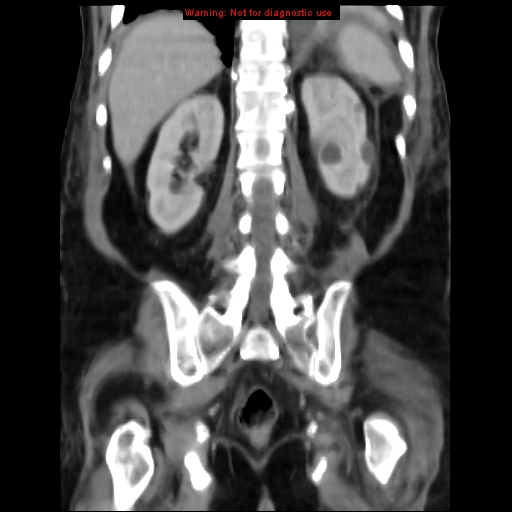 Acute pancreatitis with incidental pancreatic lipoma (Radiopaedia 10190-10730 Coronal C+ portal venous phase 55).jpg