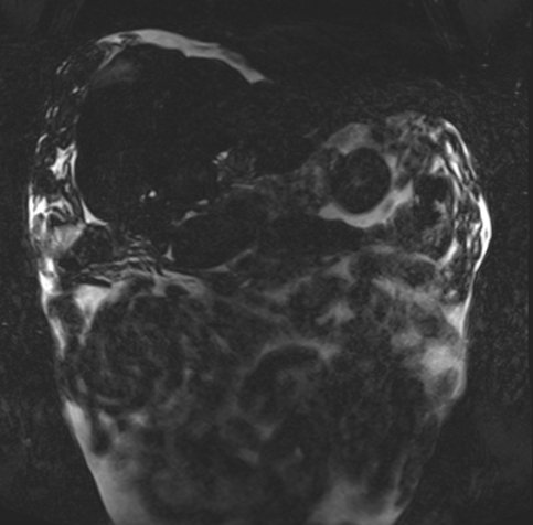 Acute portal vein thrombosis (Radiopaedia 73198-83925 Coronal Heavily T2 thin cuts 4).jpg