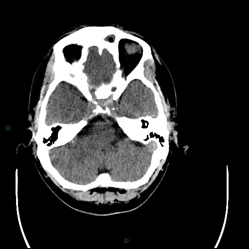 Acute posterior cerebral artery territory infarct (Radiopaedia 79329-92393 Axial non-contrast 25).jpg