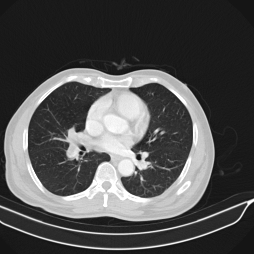 Acute pulmonary embolism (Radiopaedia 69510-79390 Axial lung window 28).jpg