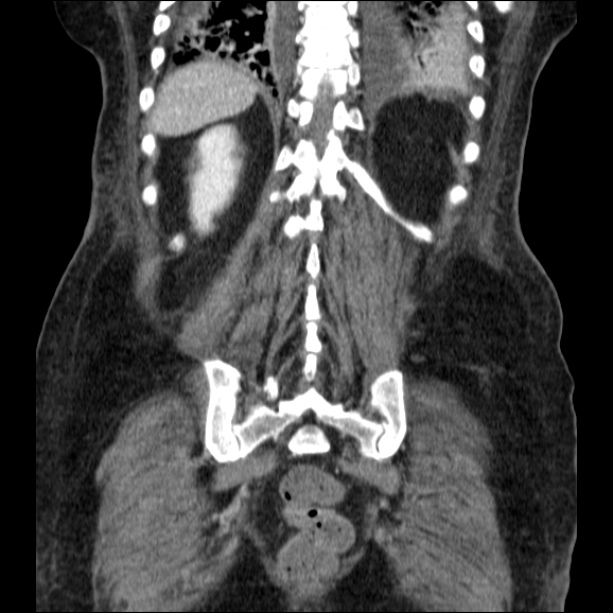 Acute pyelonephritis (Radiopaedia 26584-26729 C+ portal venous phase 59).jpg