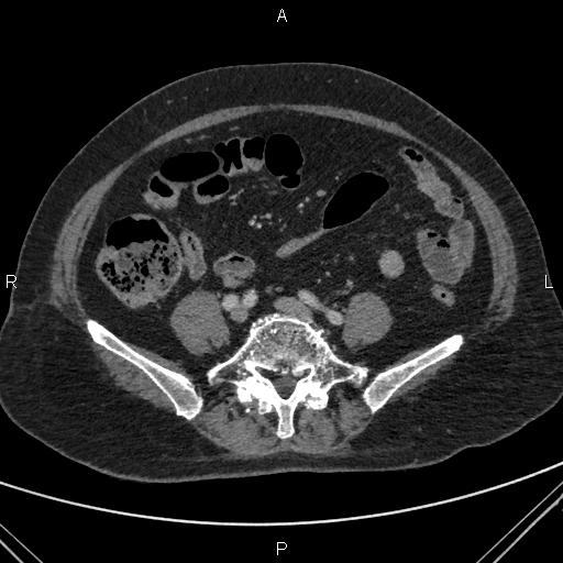 File:Acute renal artery occlusion (Radiopaedia 86586-102682 Axial C+ portal venous phase 64).jpg