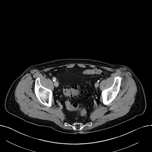 File:Acute renal infarction (Radiopaedia 59375-66736 Axial C+ portal venous phase 99).jpg