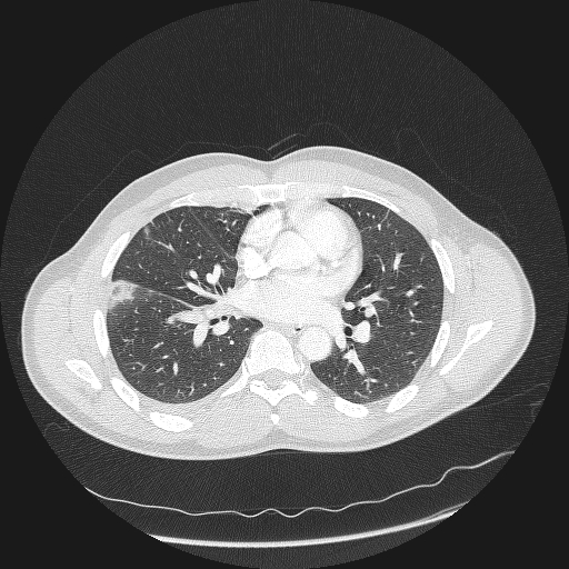 Acute segmental pulmonary emboli and pulmonary infarction (Radiopaedia 62264-70444 Axial lung window 98).jpg