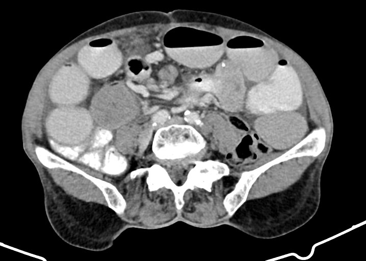 Acute small bowel (ileal) volvulus (Radiopaedia 71740-82139 Axial C+ portal venous phase 132).jpg
