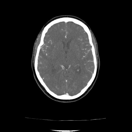Acute subarachnoid hemorrhage and accessory anterior cerebral artery (Radiopaedia 69231-79009 Axial C+ arterial phase 97).jpg