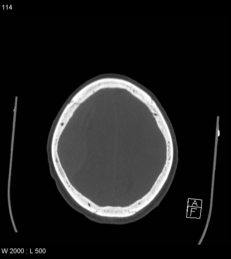 Acute subdural hematoma with myelofibrosis (Radiopaedia 52582-58494 Axial bone window 57).jpg
