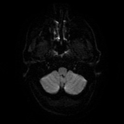 File:Acute superior cerebellar artery territory infarct (Radiopaedia 84104-99358 Axial DWI 28).jpg
