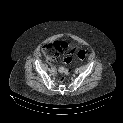 Acute superior mesenteric artery occlusion (Radiopaedia 51288-56960 Axial C+ portal venous phase 82).jpg