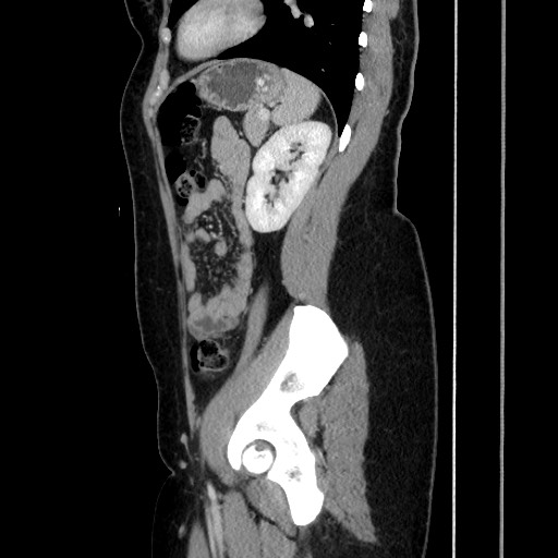 Acute uncomplicated appendicitis (Radiopaedia 73704-84499 Sagittal C+ portal venous phase 144).jpg