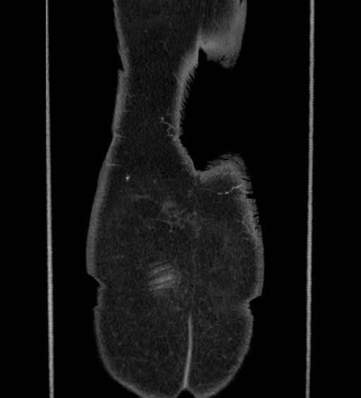 Acute uncomplicated sigmoid diverticulitis (Radiopaedia 82003-95987 Coronal C+ portal venous phase 156).jpg