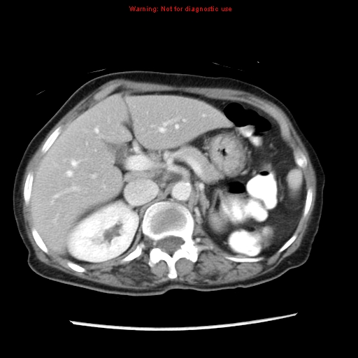 Adenocarcinoma of the colon (Radiopaedia 8191-9039 Axial liver window 23).jpg