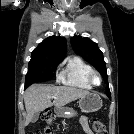 File:Adenocarcinoma of the lung (Radiopaedia 59871-67325 Coronal C+ arterial phase 14).jpg
