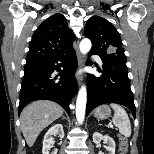 Adenocarcinoma of the lung (Radiopaedia 59871-67325 Coronal C+ arterial phase 44).jpg
