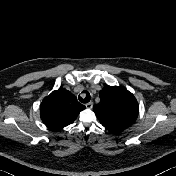 Adenoid cystic carcinoma of the trachea (Radiopaedia 49042-54137 Axial non-contrast 56).jpg