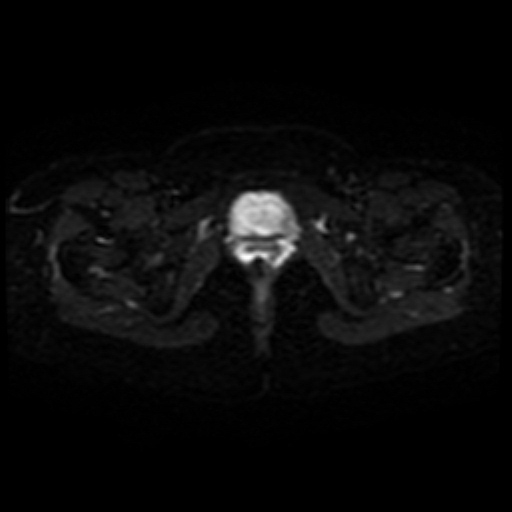 Adenoma malignum of cervix (Radiopaedia 66441-75705 Axial DWI 20).jpg