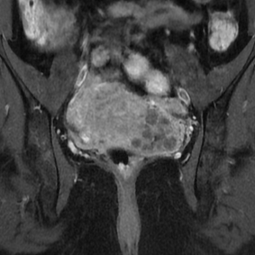 File:Adenoma malignum of cervix (Radiopaedia 66441-75705 Coronal T1 C+ fat sat 10).jpg