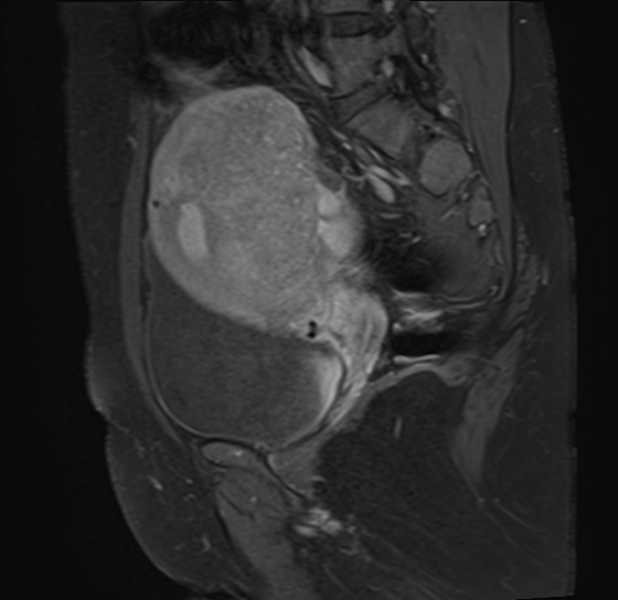 File:Adenomyosis - ovarian endometriomas (Radiopaedia 67031-76350 Sagittal T1 C+ fat sat 16).jpg