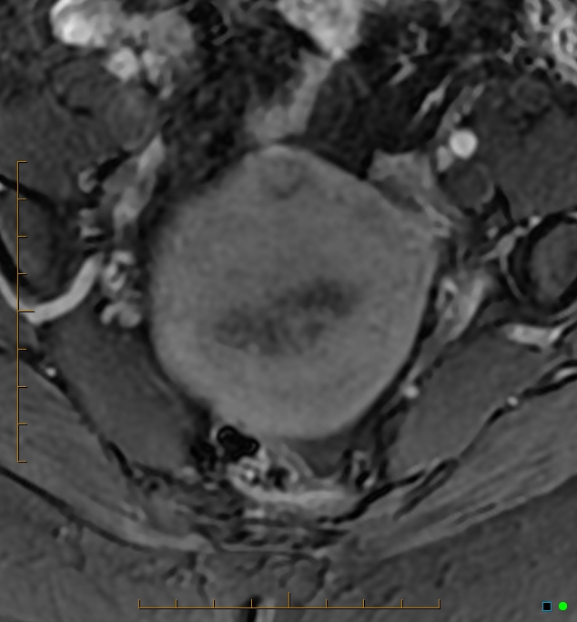 Adenomyosis uterus with hematometra (Radiopaedia 45779-50011 Axial T1 C+ fat sat 13).jpg