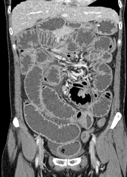 File:Adhesional small bowel obstruction (Radiopaedia 48397-53305 Coronal C+ portal venous phase 129).jpg