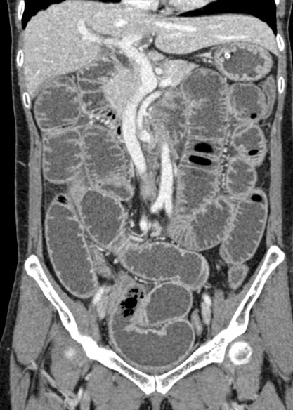 Adhesional small bowel obstruction (Radiopaedia 48397-53305 Coronal C+ portal venous phase 153).jpg