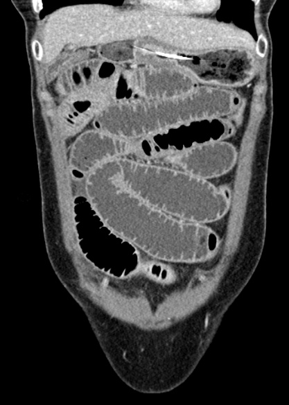Adhesional small bowel obstruction (Radiopaedia 48397-53305 Coronal C+ portal venous phase 82).jpg