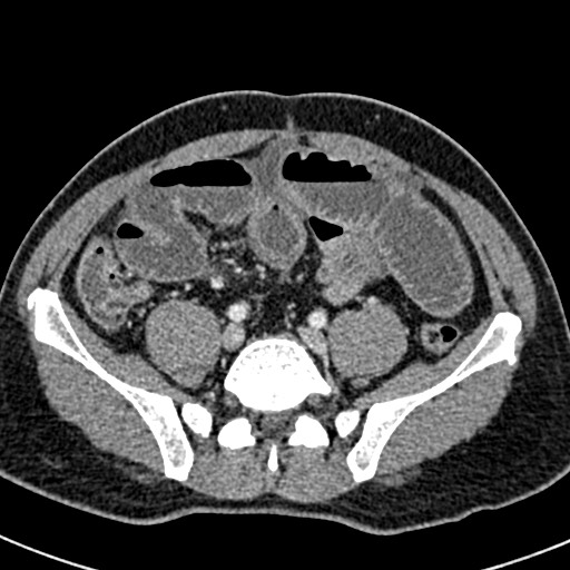 Adhesional small bowel obstruction (Radiopaedia 58900-66131 Axial C+ portal venous phase 37).jpg