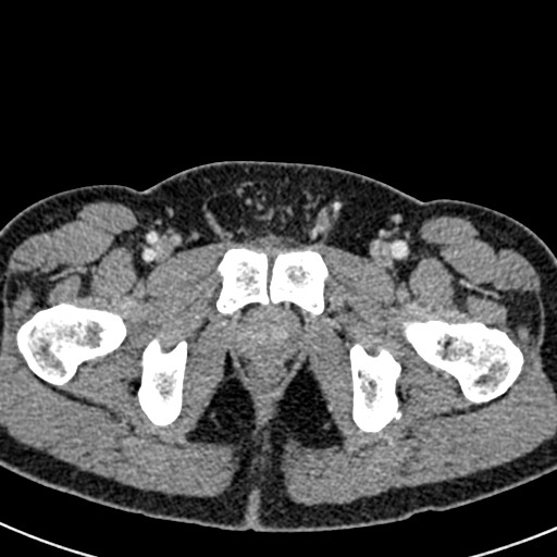 Adhesional small bowel obstruction (Radiopaedia 58900-66131 Axial C+ portal venous phase 54).jpg