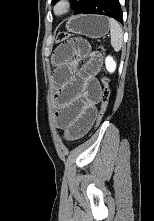 Adhesional small bowel obstruction (Radiopaedia 58900-66131 Sagittal C+ portal venous phase 207).jpg