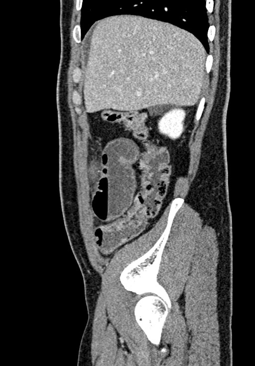 Adhesional small bowel obstruction (Radiopaedia 58900-66131 Sagittal C+ portal venous phase 50).jpg