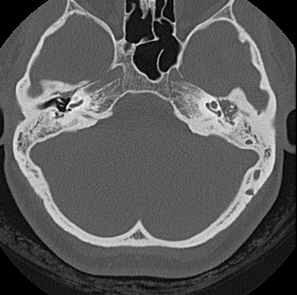 File:Adhesive chronic otitis media (Radiopaedia 14270-14148 Axial bone window 8).jpg