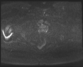 Adnexal multilocular cyst (O-RADS US 3- O-RADS MRI 3) (Radiopaedia 87426-103754 Axial DWI 83).jpg