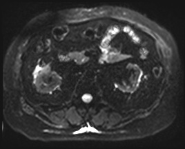 File:Adrenal cortical carcinoma (Radiopaedia 64017-72770 Axial DWI 24).jpg