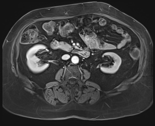 File:Adrenal cortical carcinoma (Radiopaedia 64017-72770 J 50).jpg