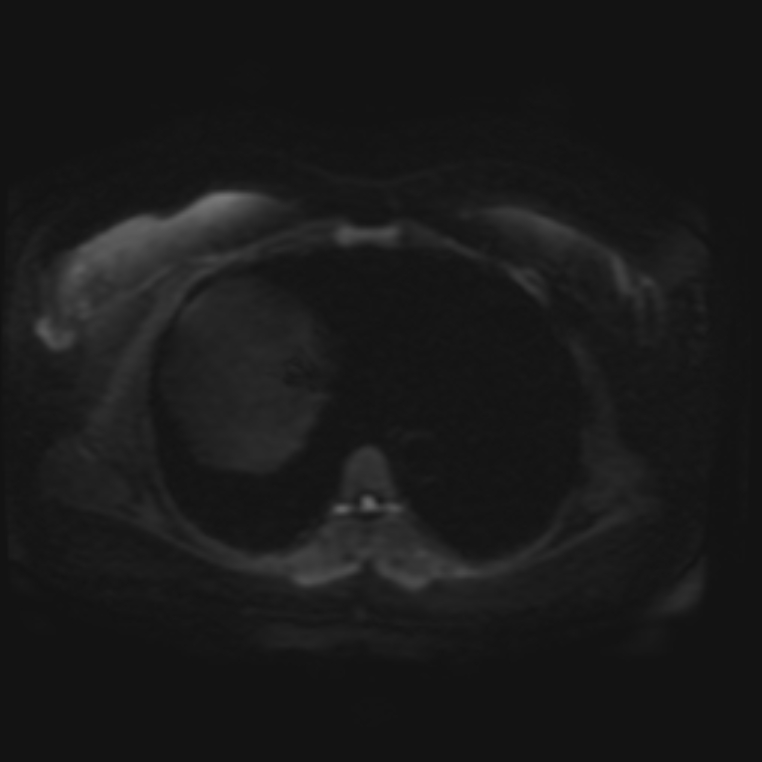 Adrenal cortical carcinoma (Radiopaedia 70906-81116 Axial DWI 1).jpg