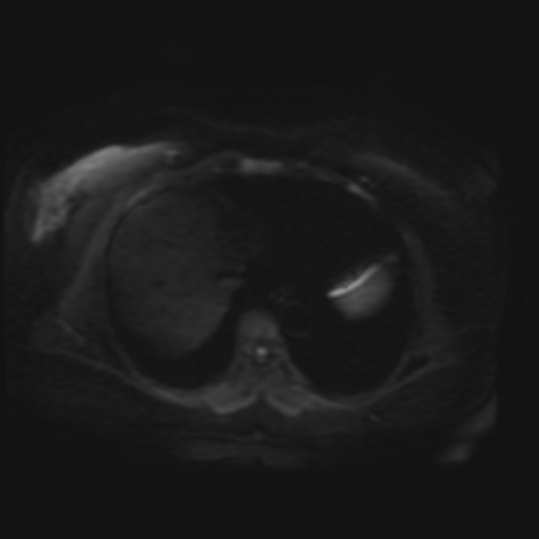 Adrenal cortical carcinoma (Radiopaedia 70906-81116 Axial DWI 2).jpg