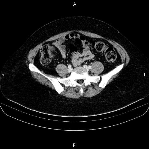 Adrenal cortical carcinoma (Radiopaedia 84882-100379 Axial C+ portal venous phase 66).jpg