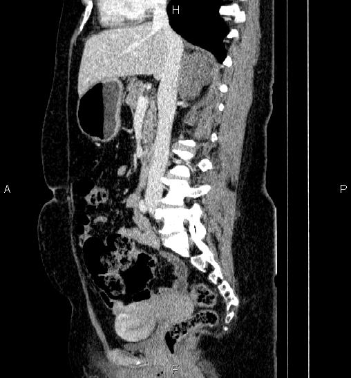 File:Adrenal cortical carcinoma (Radiopaedia 84882-100379 Sagittal C+ portal venous phase 42).jpg