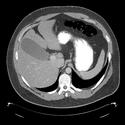 Adrenal cyst (Radiopaedia 45625-49776 Axial C+ portal venous phase 24).png