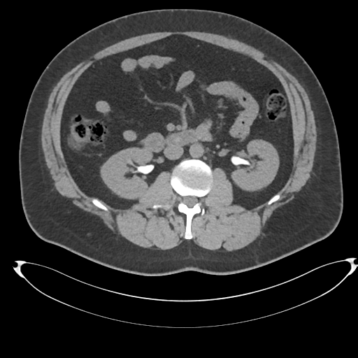Adrenal cyst (Radiopaedia 45625-49778 Axial non-contrast 54).png