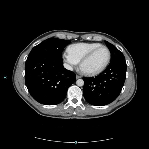 Adrenal cystic lymphangioma (Radiopaedia 83161-97534 Axial C+ portal venous phase 4).jpg