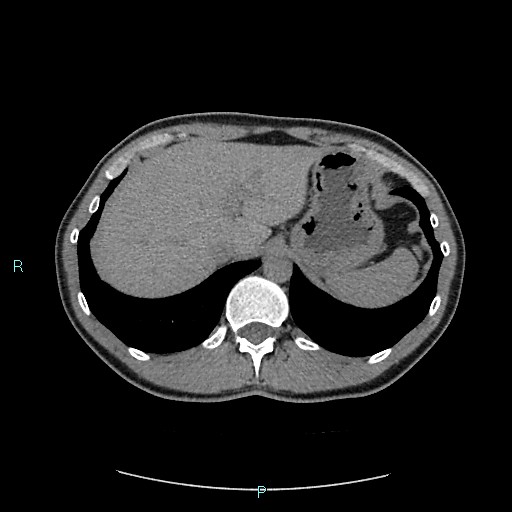 Adrenal cystic lymphangioma (Radiopaedia 83161-97534 Axial non-contrast 21).jpg