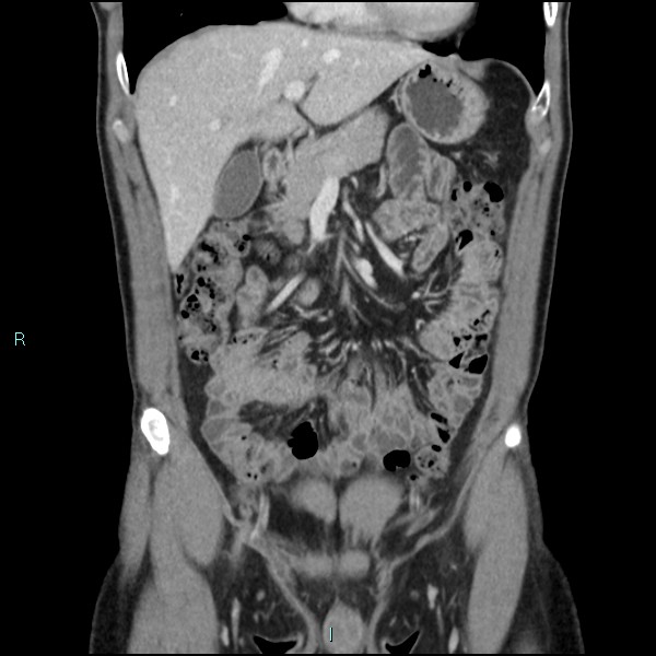 Adrenal cystic lymphangioma (Radiopaedia 83161-97534 Coronal C+ portal venous phase 25).jpg