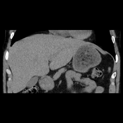 File:Adrenal gland trauma (Radiopaedia 81351-95079 Coronal non-contrast 33).jpg